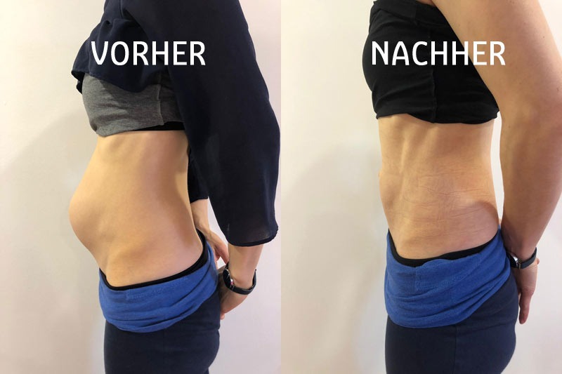 Vorher-nachher-Aufnahmen der Körpermitte in Seitenansicht